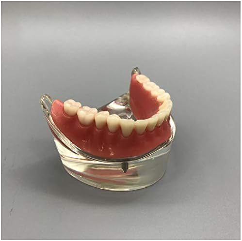 מודל השתלת שיניים של KH66Zky - מודל שיניים - הדגמת שתלים נחותה של מנדבולולרי 2 להוראה ולימוד