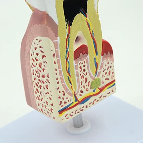 הדגמת שיניים מגדלת פתולוגית של UCCE מודל עששת עששת נגעים